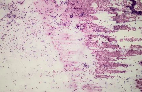 Microscopic image showing a non-Hodgkin lymphoma. Stock Illustration