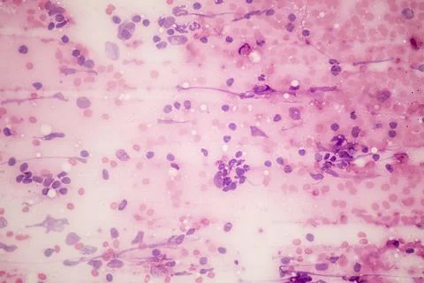 Microscopic image showing a non-Hodgkin lymphoma. Stock Illustration