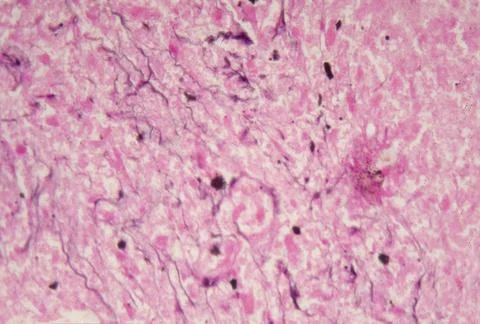 Microscopic view of Histoplasma capsulatum, PAS staining Foto stock