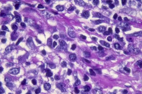Microscopic view of PAS Stain of a biopsy showing long-standing histoplasmosis. Stock Photos