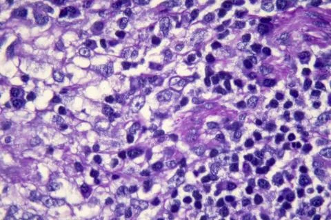 Microscopic view of PAS Stain of a biopsy showing long-standing histoplasmosis. Foto stock