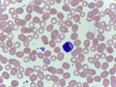 Microscopic View of a Peripheral Blood Smear Showing Red Blood Cells and Wh.. Foto stock