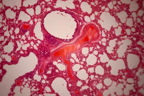 Microscopically stained section of lung tissue showing. Stockfoto's