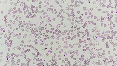 Microscopicfootage showing severe microcytic hypochromic anemia. Video stock 337723249