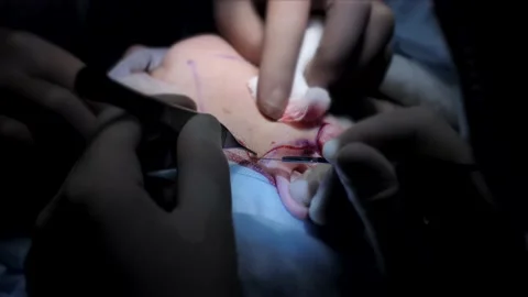 Microsurgery, plastic surgery facelift operation. Surgeon is cutting off the Stock Footage 130599697