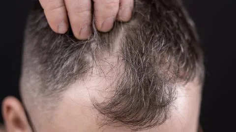 A middle-aged man has gray hair and is experiencing hair loss. He is concer.. Stock-Fotos