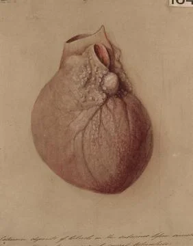 Miliary tubercles in the sub-serous tissue investing the heart Stock Illustration