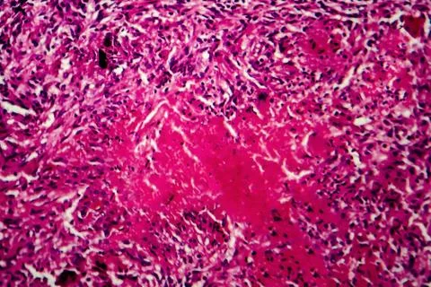 Miliary tuberculosis, light micrograph Stock Photos