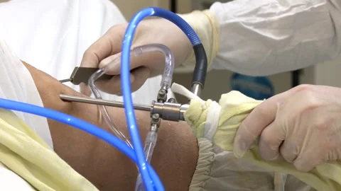 Minimal invasive joint arthroscopic procedure Video stock 314962845