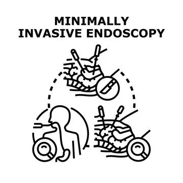 Minimally invasive endoscopy procedure, keyhole surgery concept Stock Illustration