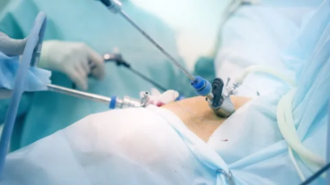 Minimally Invasive Laparoscopic Surgery Procedure with Advanced Medical Tool Stock Footage 296929636