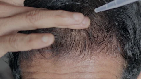 Minoxidil, essential oil, man using hair serum on head. Stock Footage 303326345