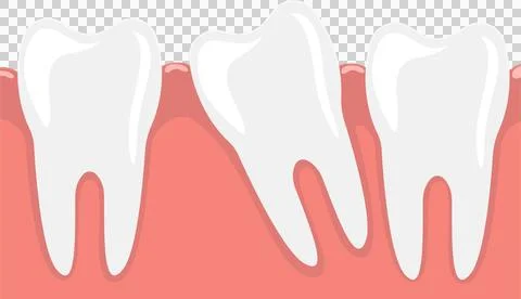 Misaligned teeth, also known as malocclusion, can cause problems with chewi.. Stock Illustration