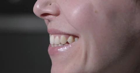 Misaligned Teeth with Prominent Canine Tooth Above the Dental Line Stock Footage 263083556