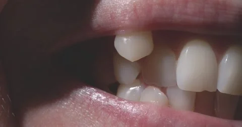 Misaligned Teeth with Prominent Canine Tooth Above the Dental Line Stock Footage 263083558