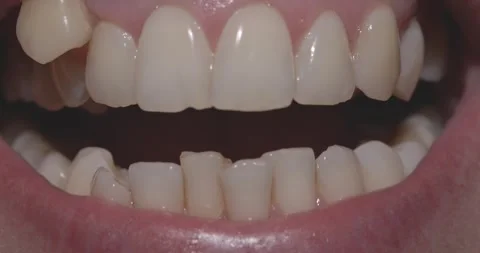 Misaligned Teeth with Prominent Canine Tooth Above the Dental Line Stock Footage 263083572
