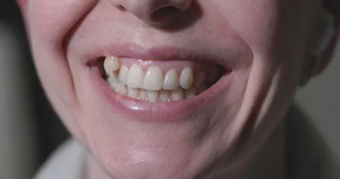 Misaligned Teeth with Prominent Canine Tooth Above the Dental Line Stock Footage 263083575