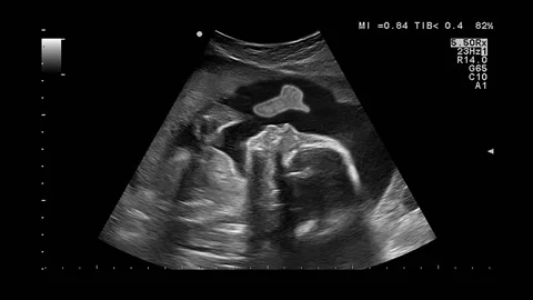 Miscarriage and abortion Stock Footage 111706534