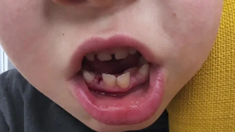 Missing Front Teeth Child Mouth Macro Concept of Tooth Change and Dentistry Video stock 336467064