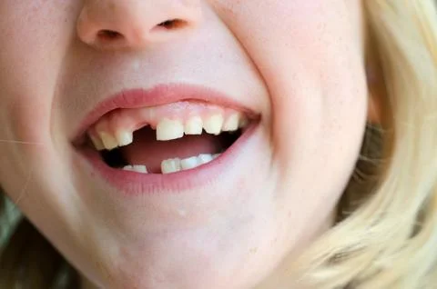 Missing tooth Foto stock