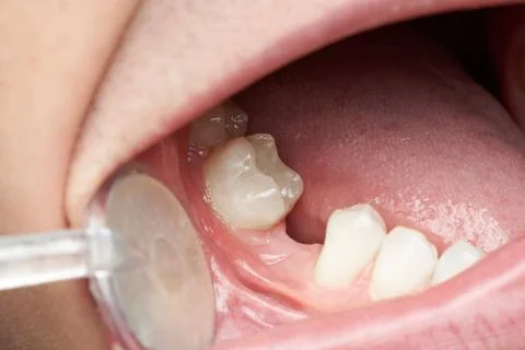 Missing tooth space in mouth Stock Photos
