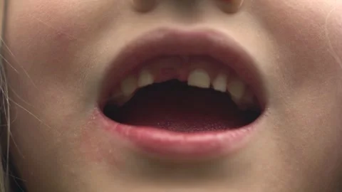 Missing Upper Front Baby Tooth After Her First Tooth Falls Out Vidéo 343894803