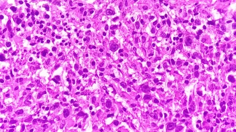 Mixed cellularity classic Hodgkin lymphoma (MCCHL) Video stock 337723121