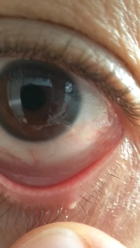 A mobile phone shot from a man checking the condition of a stye that is an infla Stock Footage 249019975