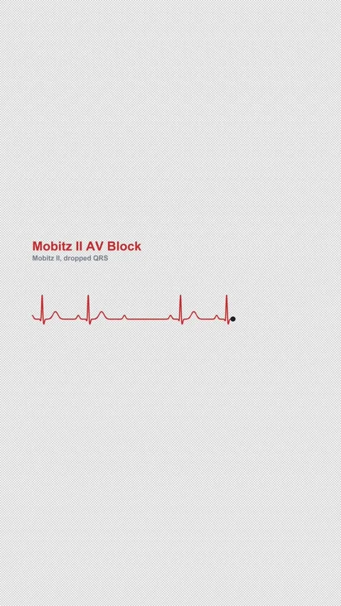 Mobitz II AV Block ECG Heart Rhythm Labeled Overlay Alpha 4K Vertical 9x16 Light Stockbeeldmateriaal 339507197