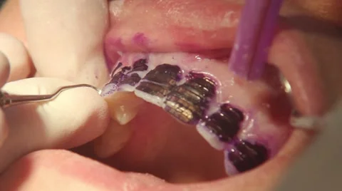 Mock up dental procedure Stock Footage 61156291