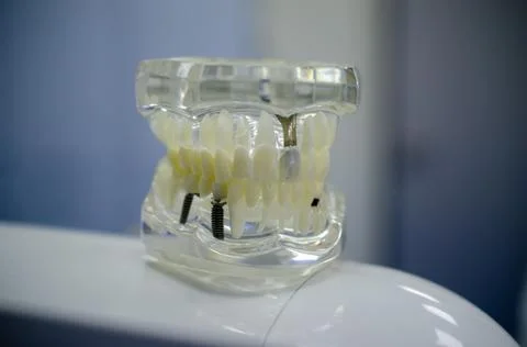 Mock up a sample of the upper and lower jaw in the dentist's office. Stock Photos