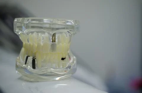 Mock up a sample of the upper and lower jaw in the dentist's office. Stock Photos