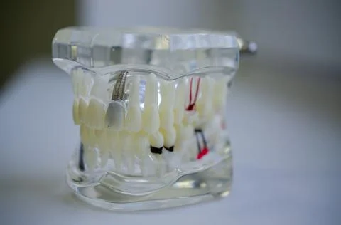Mock up a sample of the upper and lower jaw in the dentist's office. Stock Photos