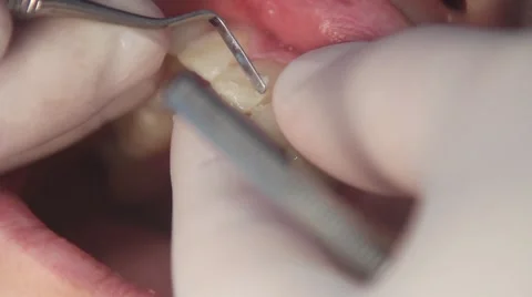 Mockup dental procedure Stock Footage 61156351