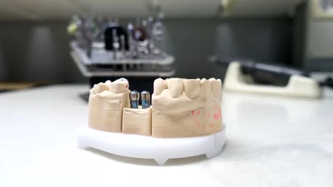 Model of the human jaw with dental implants Stock Footage 344167099