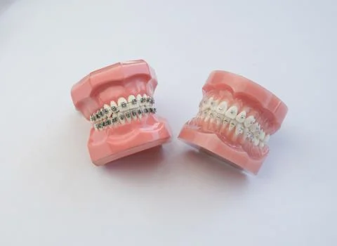 Model of human jaw with wire braces attacheg  Dental and orthodontic office.. Stock Photos