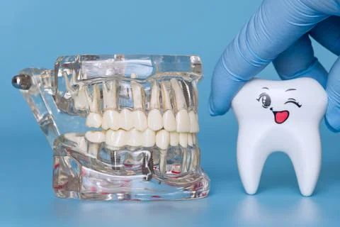 Model of a jaw with implants and a winking tooth Stock Photos