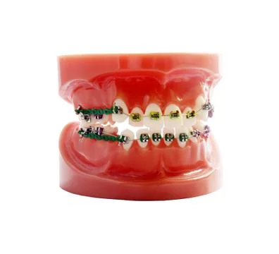 Model of jaws with bracket system on white Stock Photos