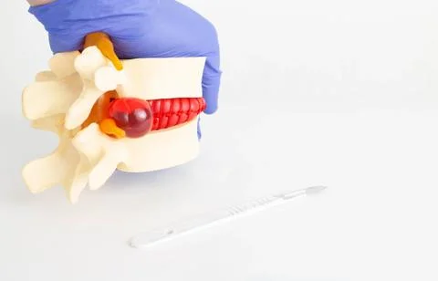 A model of the spine with an intervertebral hernia next to which lies a surgical Foto stock