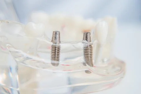 A model of teeth with implants lies on a table Stock Photos
