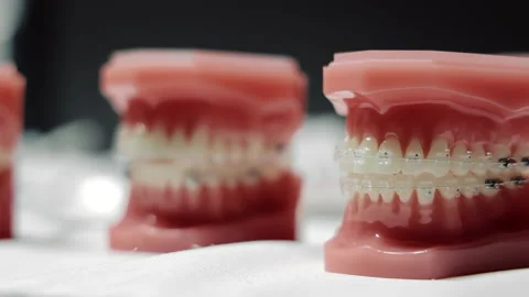 Model of the tooth gap on the placement of orthodontic brackets. Variants of Stock Footage 168987423