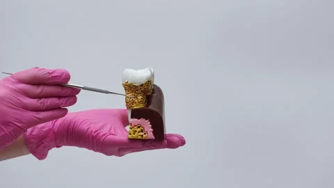 Model of a tooth with periodontitis: a dentist points to tartar and makes Stock Footage 333550361