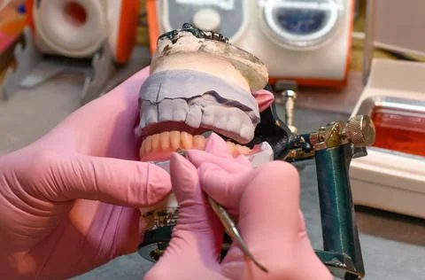 Modeling the installation of a denture with wax. Stockfoto's