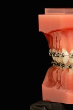 Models of teeth with braces on teeth on a jaw Foto stock