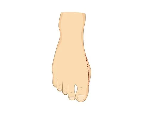 Moderate bunion surgery correction. Stock Illustration