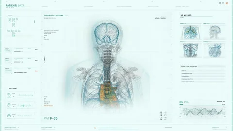 Modern Anatomical Diagnostic Analysis Software Finds Tumor In Patients Brain Stock Footage 166541848
