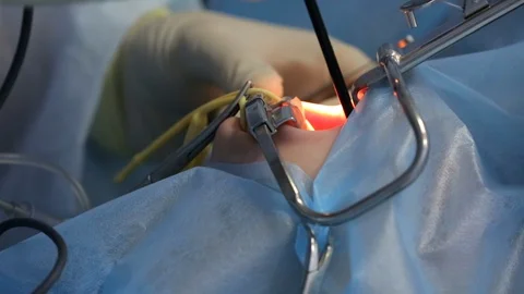 Modern clinic, deep anesthesia, using latest devices patient removes glands Stock Footage 128642971