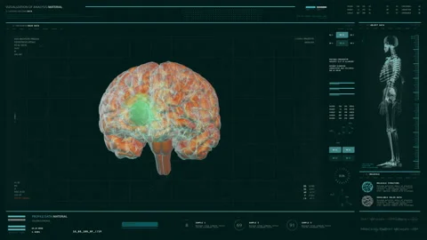 Modern medical scan system interface detects the brain tumor growth in a patient Stock Footage 164781292