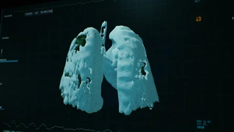 Modern medical user interface. 3D lung creating on Computer screen. Modern CT Video stock 148782940