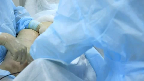 Modern method of treatment of varicose veins Stock Footage 241139985